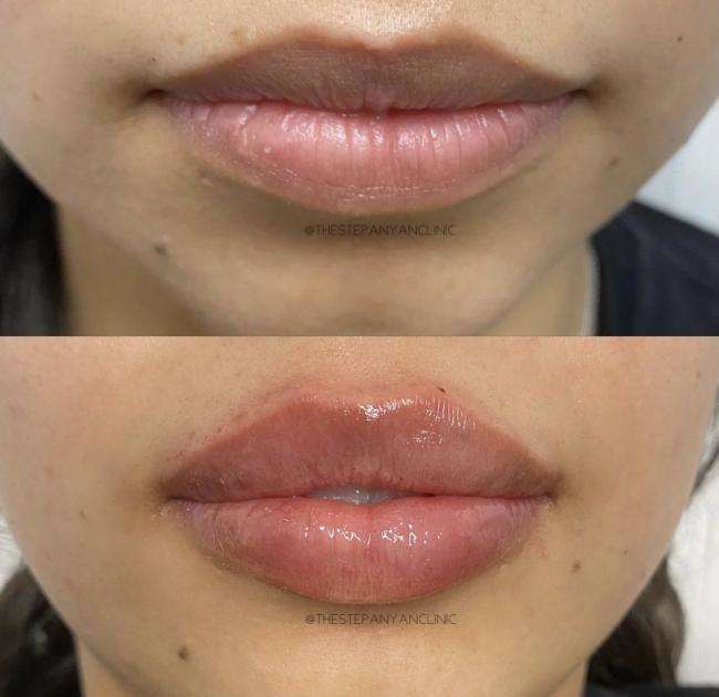 The smart Trick of Skin Tightening, Botox And Lip Fillers By Skinsation La Gift ... That Nobody is Talking About thumbnail