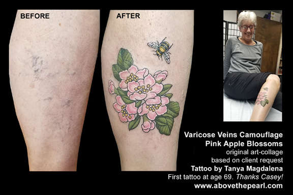 All Ink Tattoo Studio  Varicose Veins Gone  This client really hated her varicose  veins that had Appeared on the back of both her legs so muchshe never  got her legs